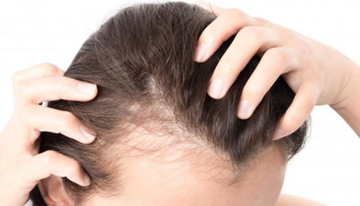 Bojujete s vážným vypadáváním vlasů? K tomu, abyste to ZASTAVILI, potřebujete pouze těchto 7 tipů..
